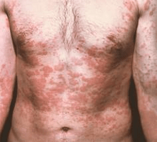 Problem skin is a symptom of the presence of parasites