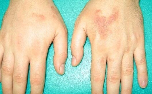 hand joint pain may be symptoms of parasites