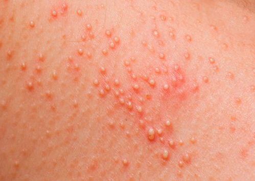 If the body is affected by parasites, a skin allergy develops. 