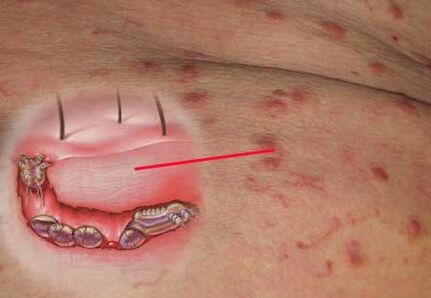 Scabies mite under human skin