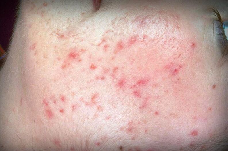Skin rash with demodicosis